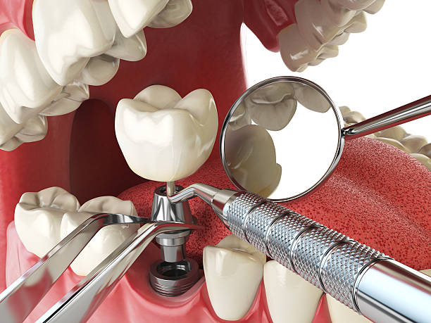 Best Urgent Tooth Repair  in Olympia, WA